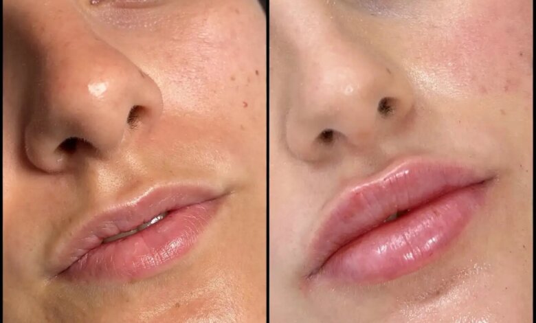 Dermal Fillers in dubai