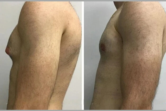 gynecomastia in dubai