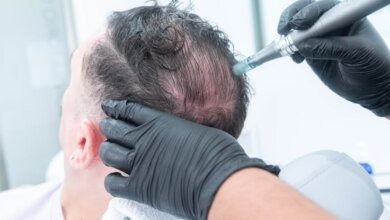How to Choose Hair Transplant Clinics in Riyadh