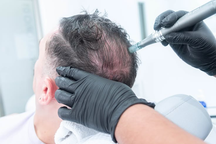 How to Choose Hair Transplant Clinics in Riyadh
