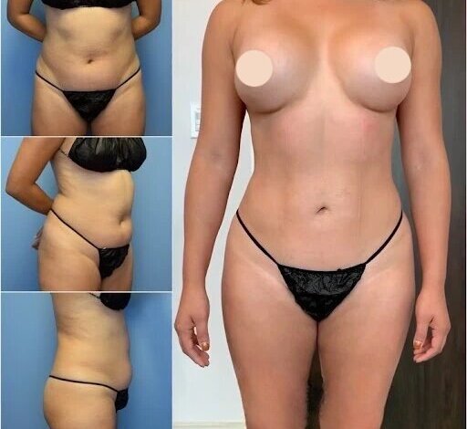 Body Contouring in dubai