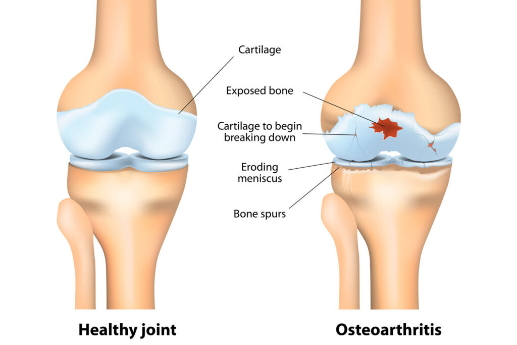 Osteoarthritis icd 10