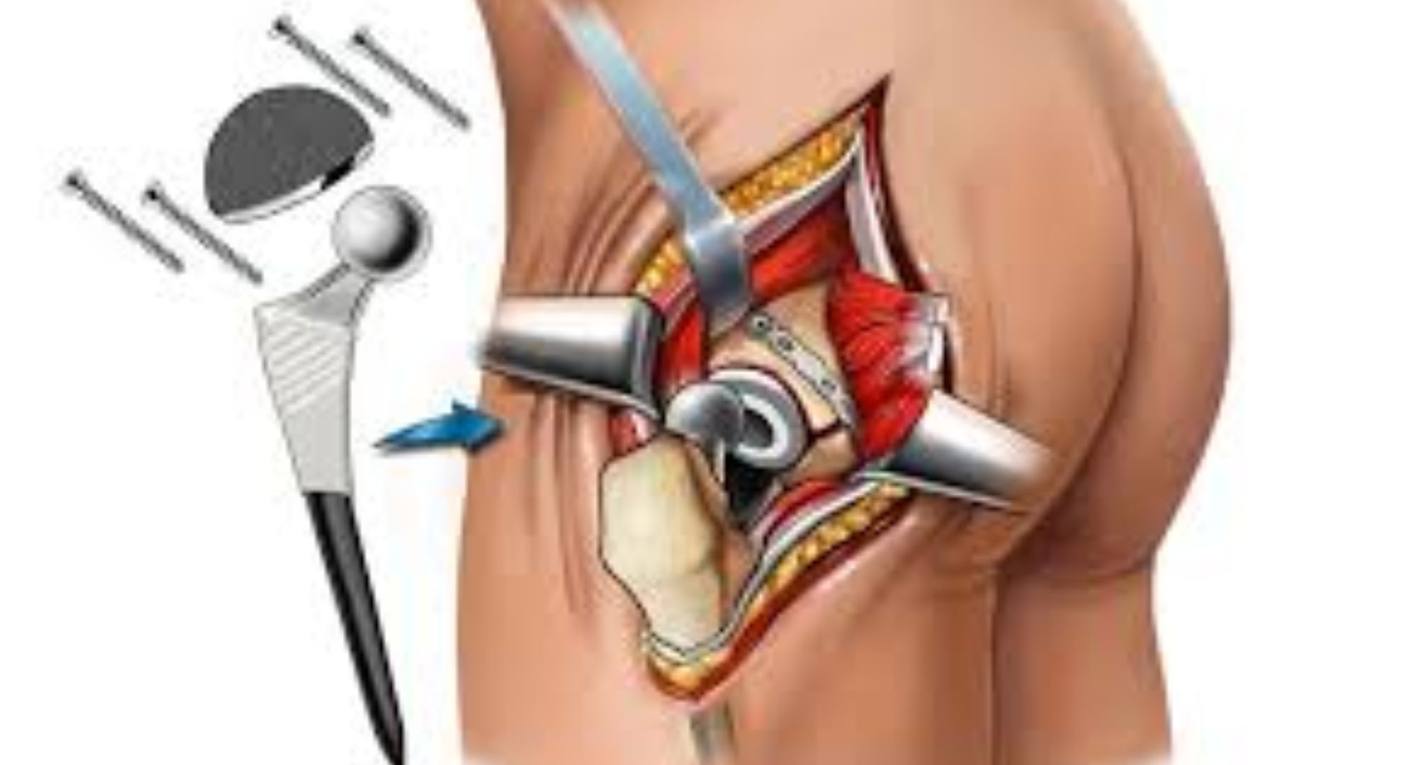 Prostate Cancer Treatment images