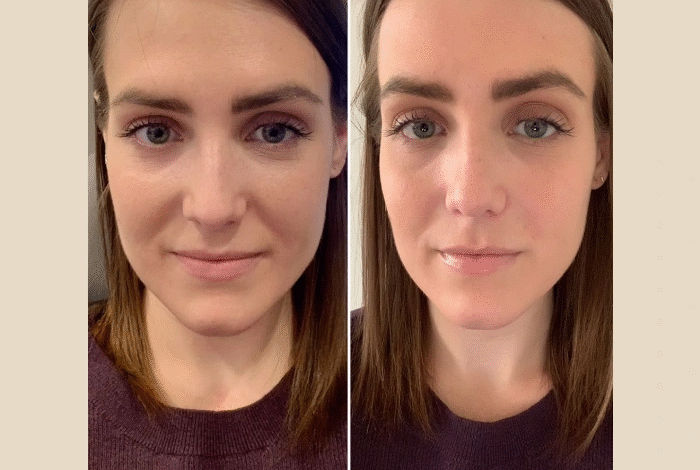 Prp Treatment in Dubai