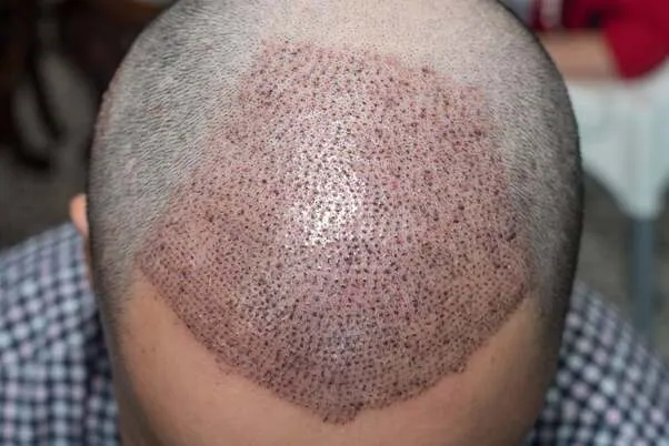 Scalp Micropigmentation in Dubai
