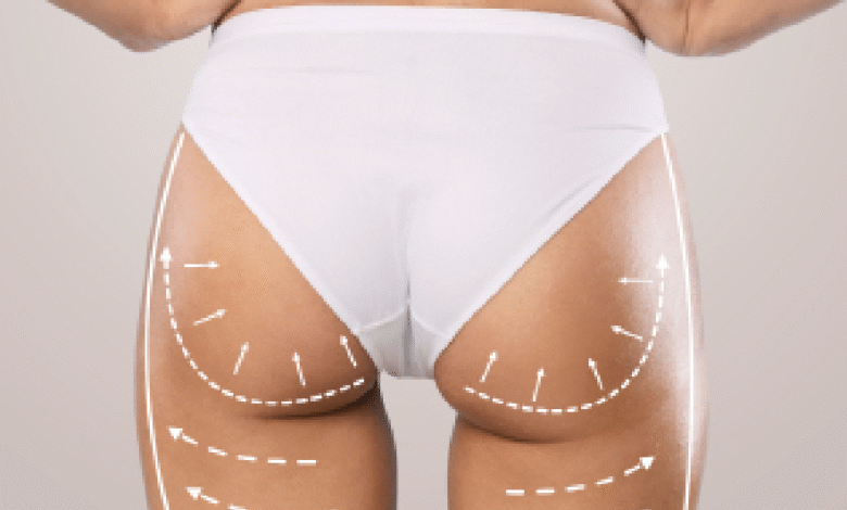 Butt Fat Transfer in Dubai