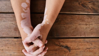 Vitiligo in hands