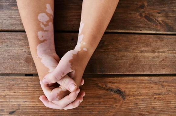 Vitiligo in hands