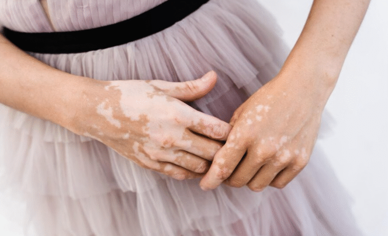 Vitiligo hand