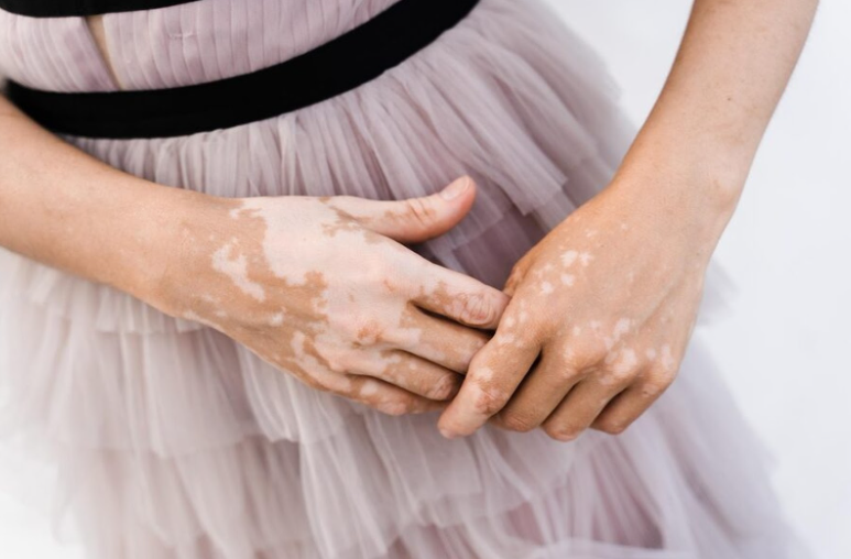 Vitiligo hand
