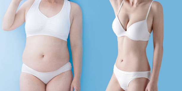 Riyadh Tummy Tuck: What to Expect Before Surgery