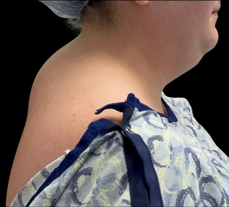 Buffalo Hump Removal in Dubai