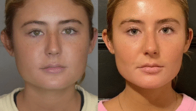 Buccal Fat Removal