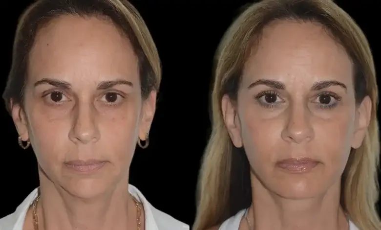 chin fillers in dubai