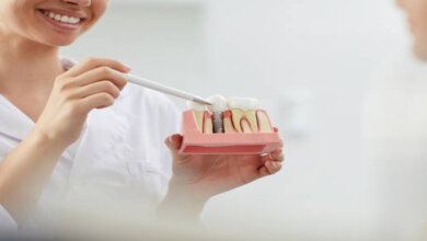 dental implants