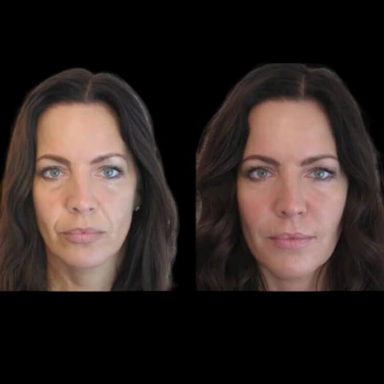 Jawline fillers in Dubai