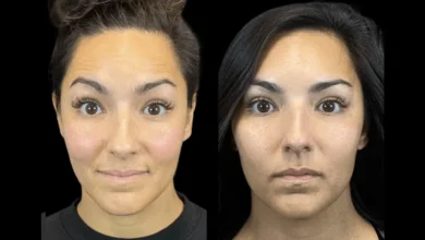 botox in dubai