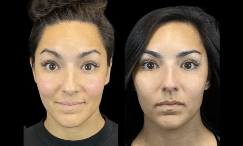 botox in dubai