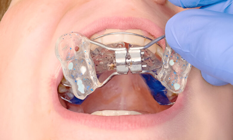 palate expander