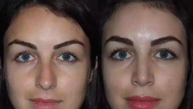 rhinoplasty in dubai