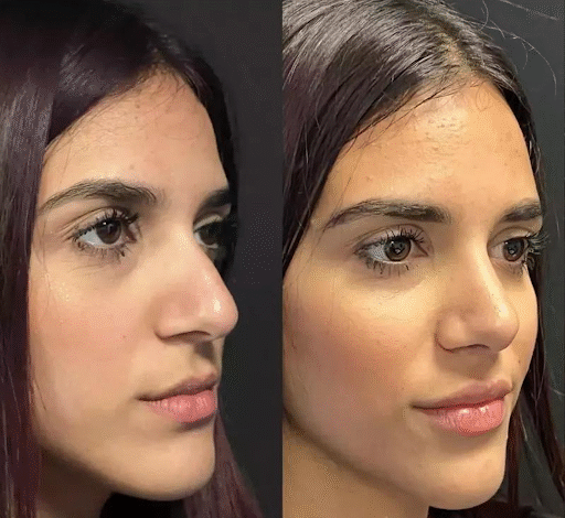 rhinoplasty-in-dubai