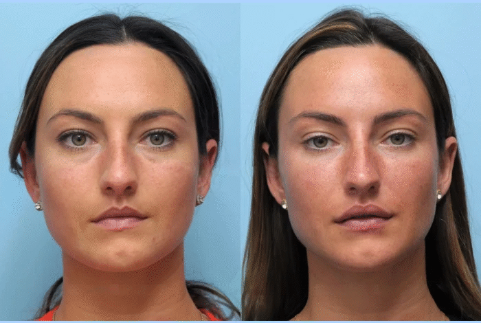 Best Doctors in Dubai for Thread Lift and Facial Rejuvenation