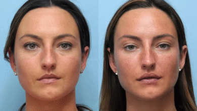 How Thread Lift in Dubai Can Transform Your Appearance