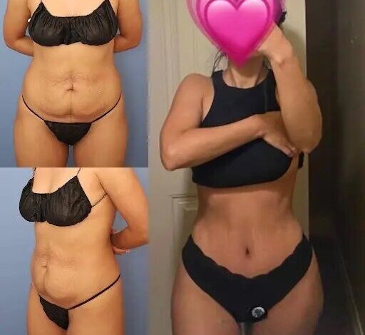 Tummy Tuck in dubai