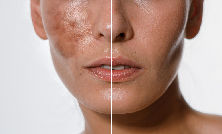 skin-whitening-treatment-in-islamabad