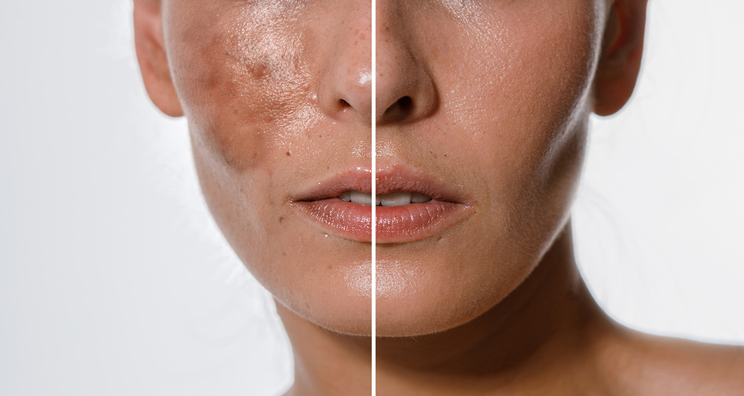 skin-whitening-treatment-in-islamabad