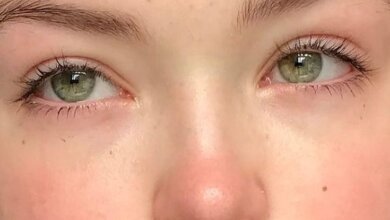 Eyelid Surgery Costs and Options in Riyadh