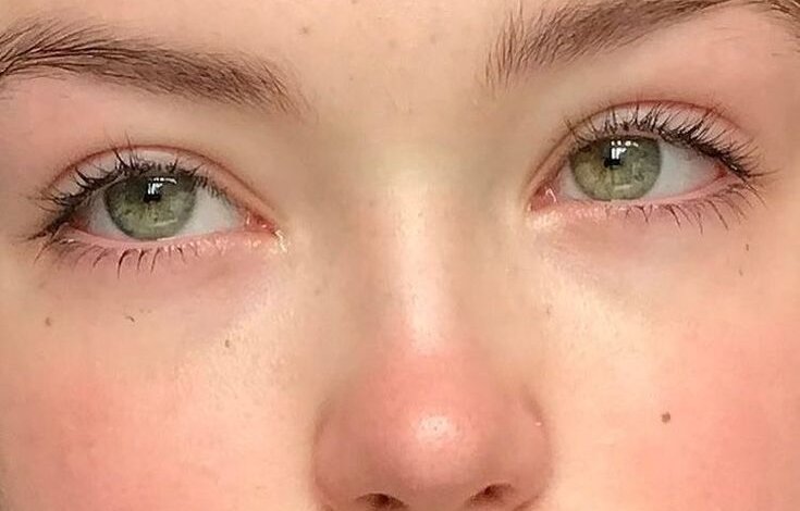 Eyelid Surgery Costs and Options in Riyadh