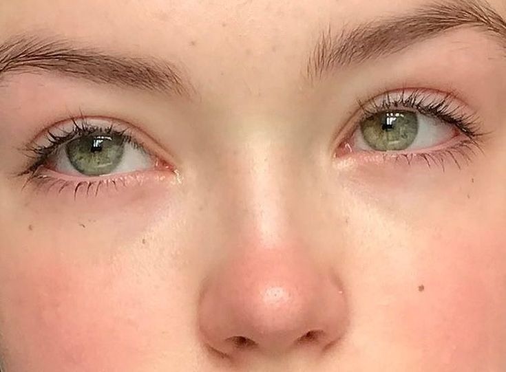 Eyelid Surgery Costs and Options in Riyadh