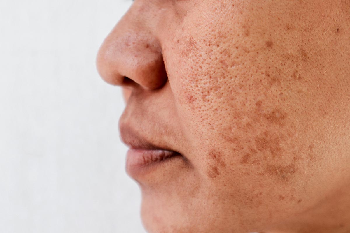 Glutathione Injection Dubai