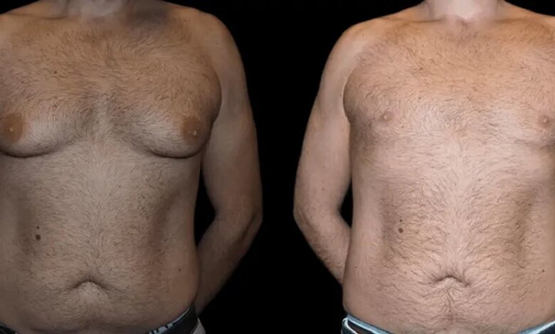 gynecomastia in dubai