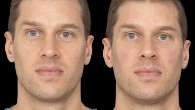 under eye fillers in dubai