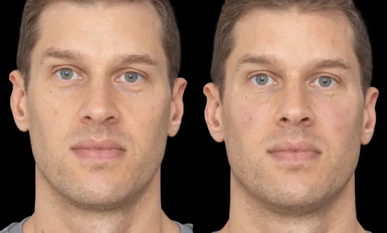 under eye fillers in dubai