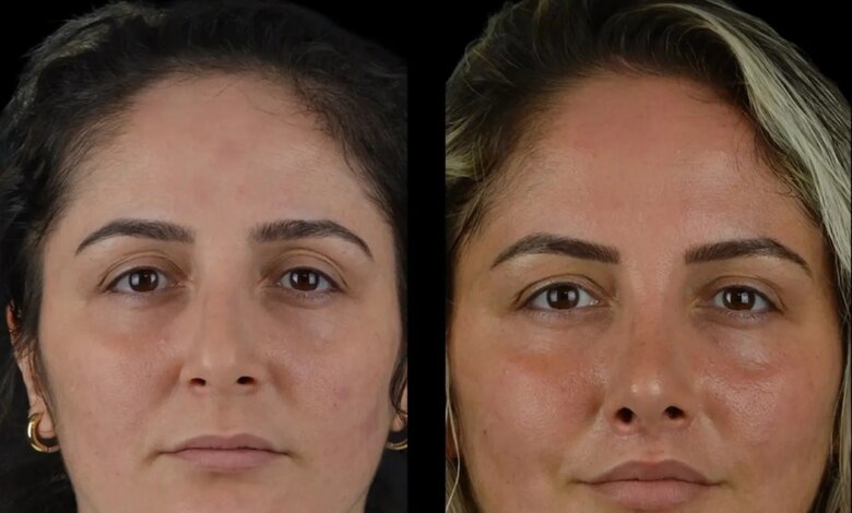 cheek fillers in dubai