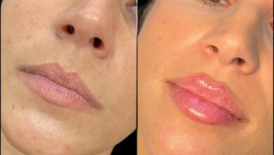 fillers in Dubai