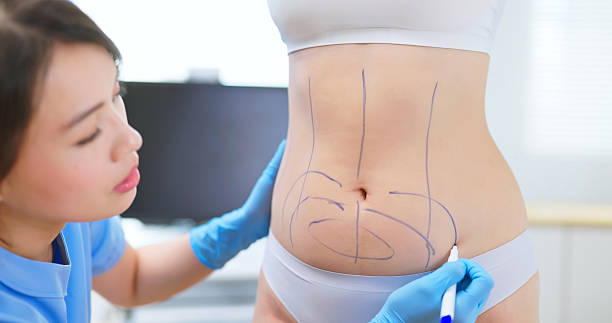 Lipo Abdonminoplasty in Riyadh
