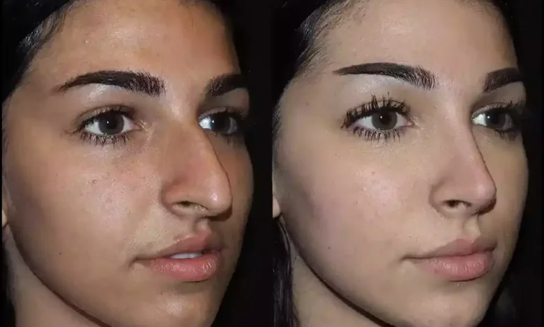 rhinoplasty in dubai