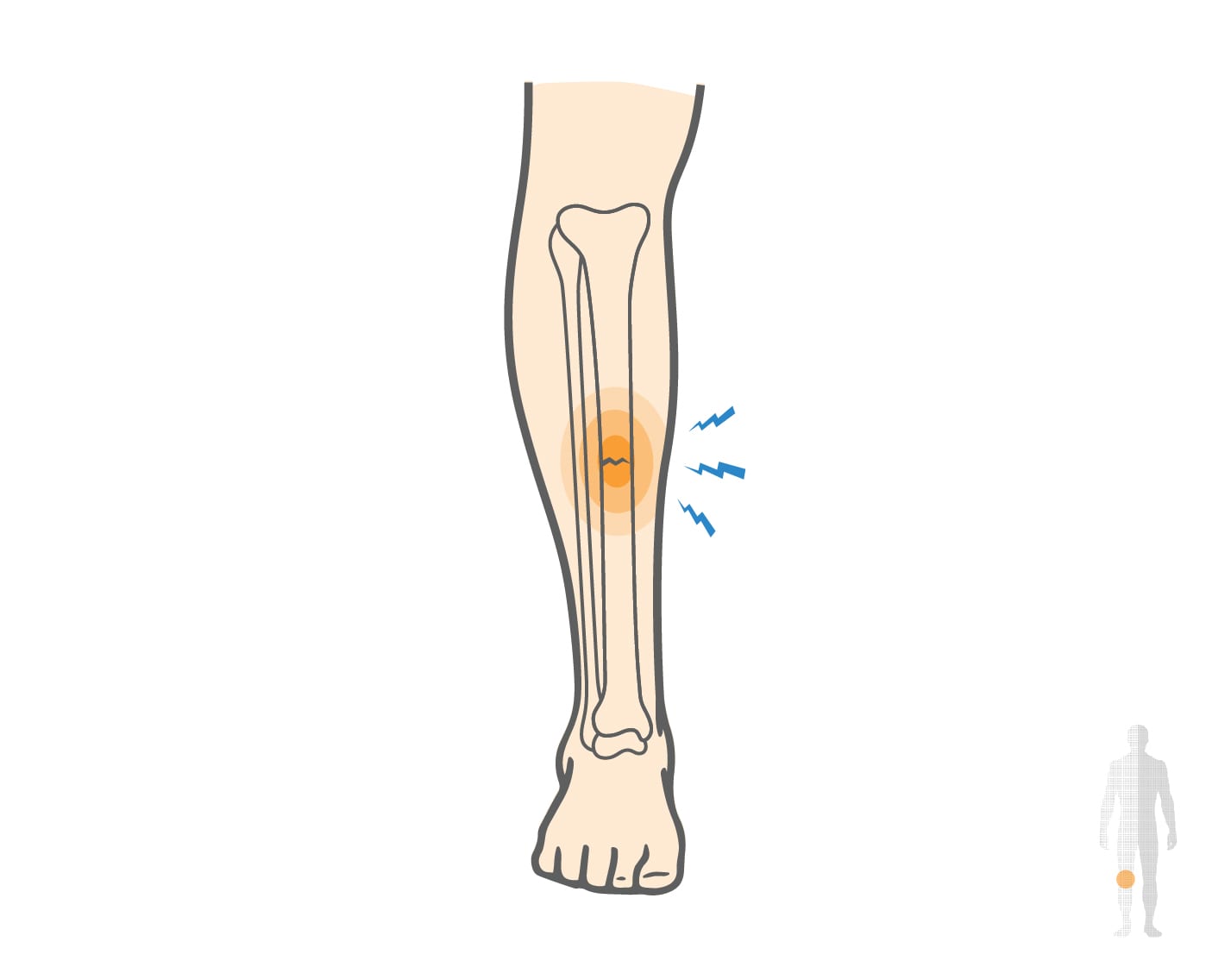 Tibia Stress Fracture