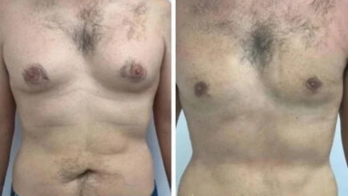 gynecomastia-in-dubai