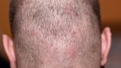 pimple-like bumps