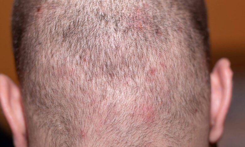 pimple-like bumps