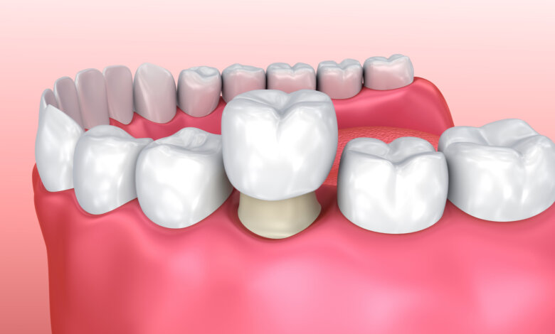 Ceramic Cap For Teeth